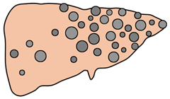 肝のう胞